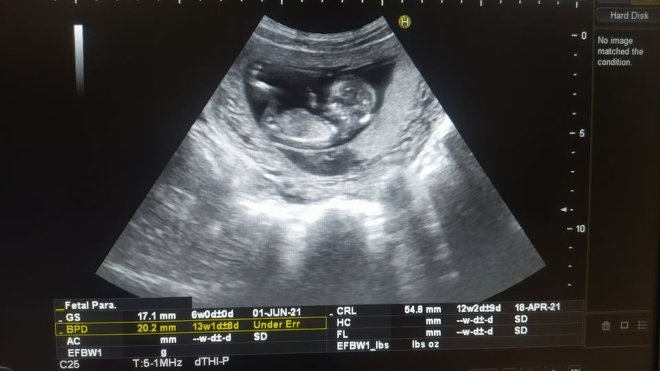 Estados Unidos | Estudio detecta mayor exposición prenatal a PFAS